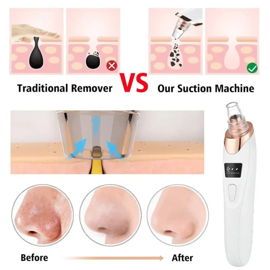 5 in 1 Rechargeable Blackhead Remover Facial Pore Cleaner Deep Cleaning — photo 6